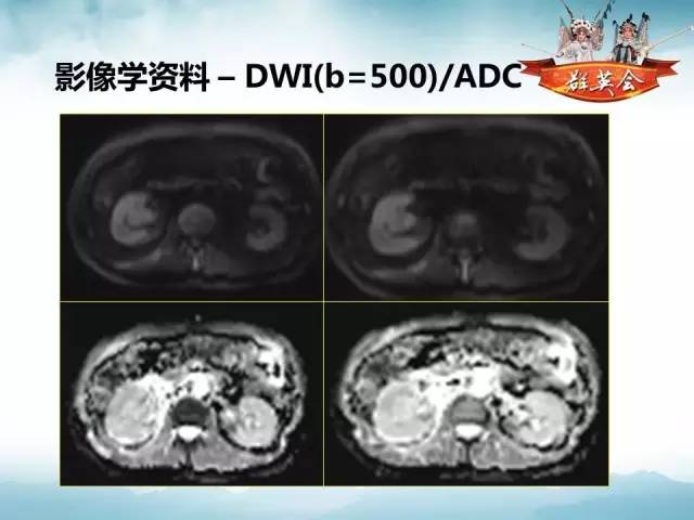 【病例】右肾血管瘤1例CT影像表现