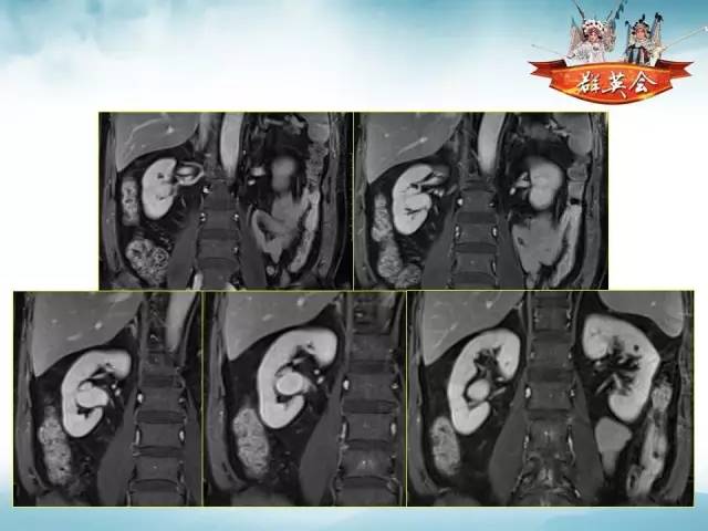 【病例】右肾血管瘤1例CT影像表现