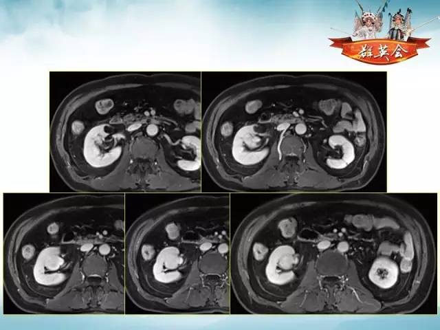 【病例】右肾血管瘤1例CT影像表现