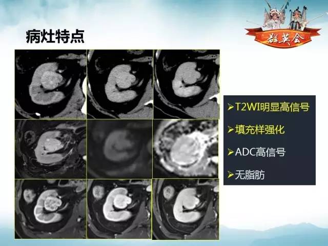 【病例】右肾血管瘤1例CT影像表现