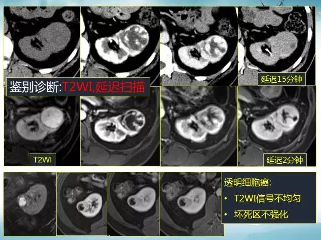 【病例】右肾血管瘤1例CT影像表现