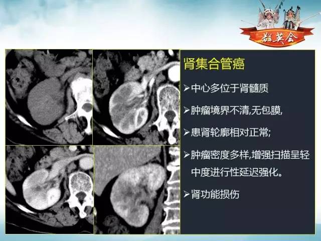 【病例】右肾血管瘤1例CT影像表现