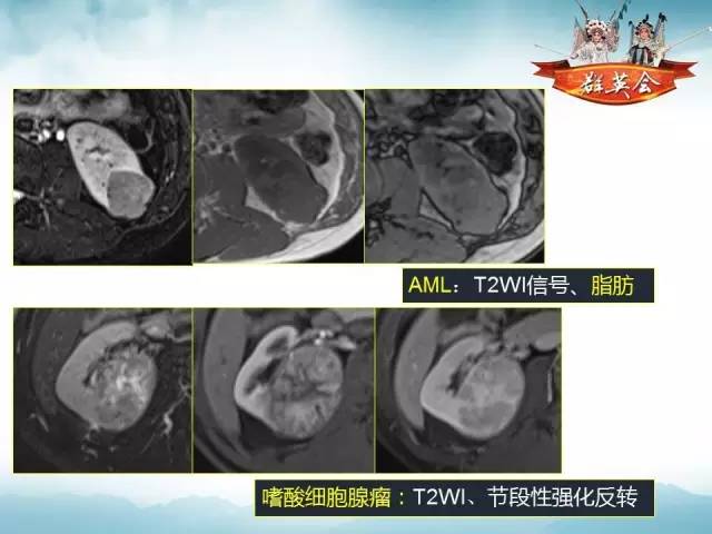 【病例】右肾血管瘤1例CT影像表现