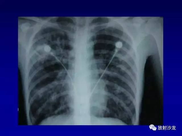 【PPT】肺真菌病的影像诊断与鉴别诊断