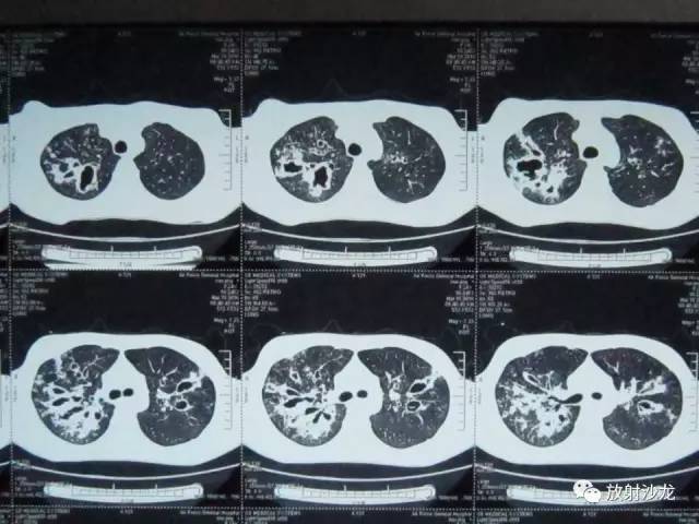 【PPT】肺真菌病的影像诊断与鉴别诊断