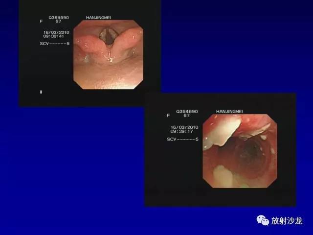 【PPT】肺真菌病的影像诊断与鉴别诊断