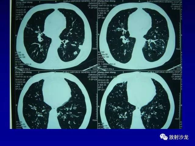 【PPT】肺真菌病的影像诊断与鉴别诊断