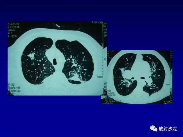 【PPT】肺真菌病的影像诊断与鉴别诊断
