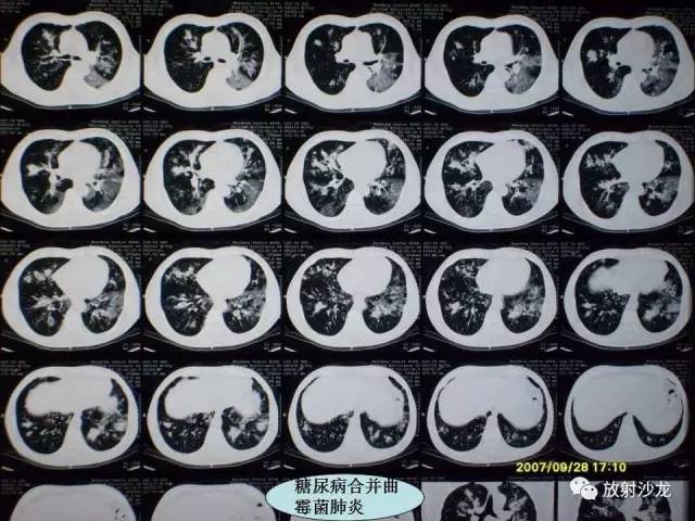 【PPT】肺真菌病的影像诊断与鉴别诊断