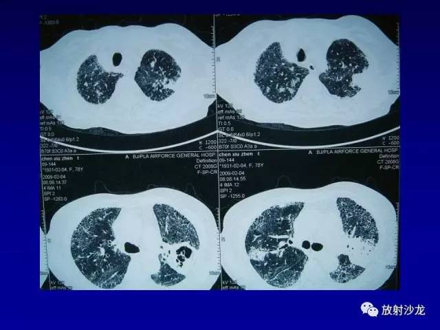 【PPT】肺真菌病的影像诊断与鉴别诊断