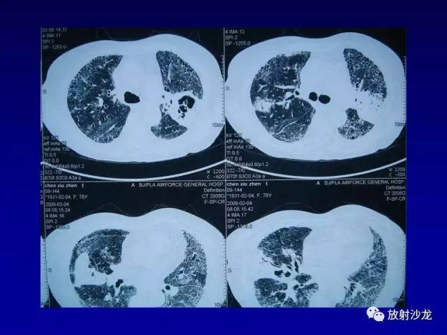 【PPT】肺真菌病的影像诊断与鉴别诊断
