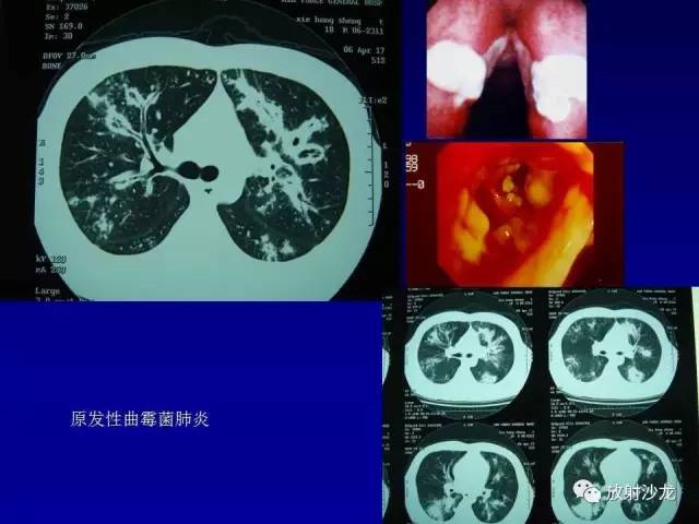 【PPT】肺真菌病的影像诊断与鉴别诊断