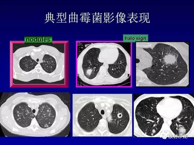【PPT】肺真菌病的影像诊断与鉴别诊断
