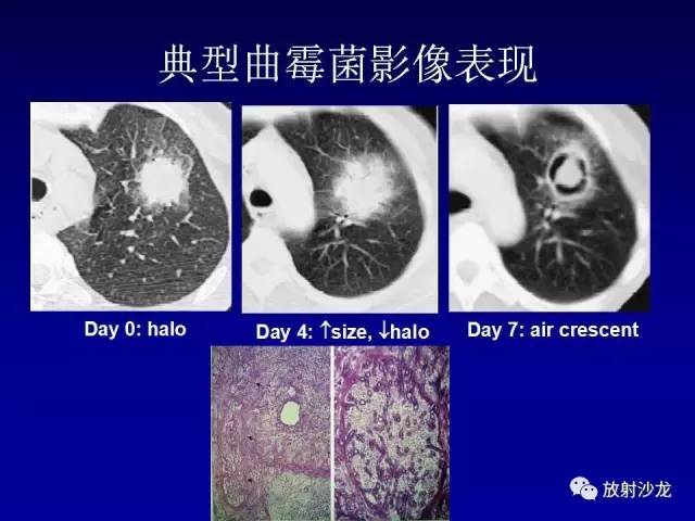 【PPT】肺真菌病的影像诊断与鉴别诊断