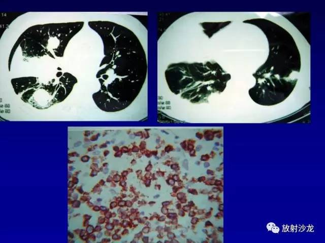 【PPT】肺真菌病的影像诊断与鉴别诊断