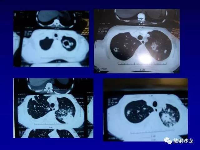【PPT】肺真菌病的影像诊断与鉴别诊断