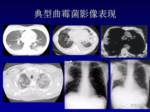 【PPT】肺真菌病的影像诊断与鉴别诊断