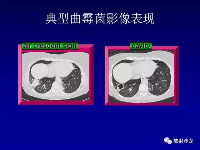 【PPT】肺真菌病的影像诊断与鉴别诊断