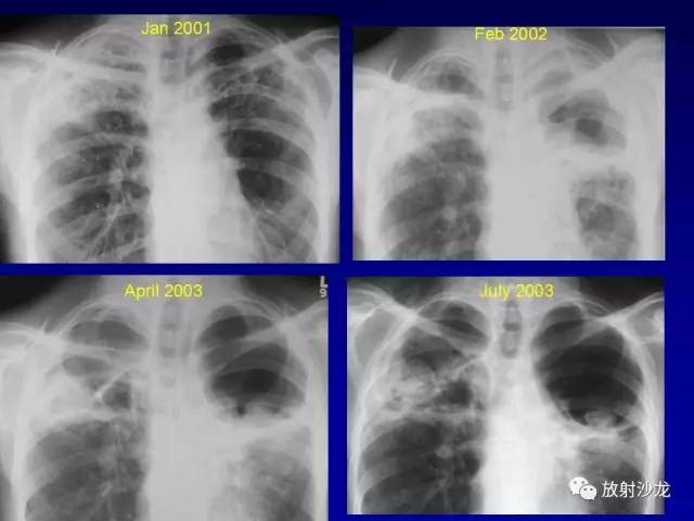 【PPT】肺真菌病的影像诊断与鉴别诊断