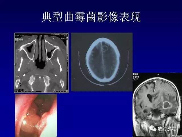 【PPT】肺真菌病的影像诊断与鉴别诊断
