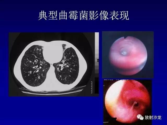【PPT】肺真菌病的影像诊断与鉴别诊断