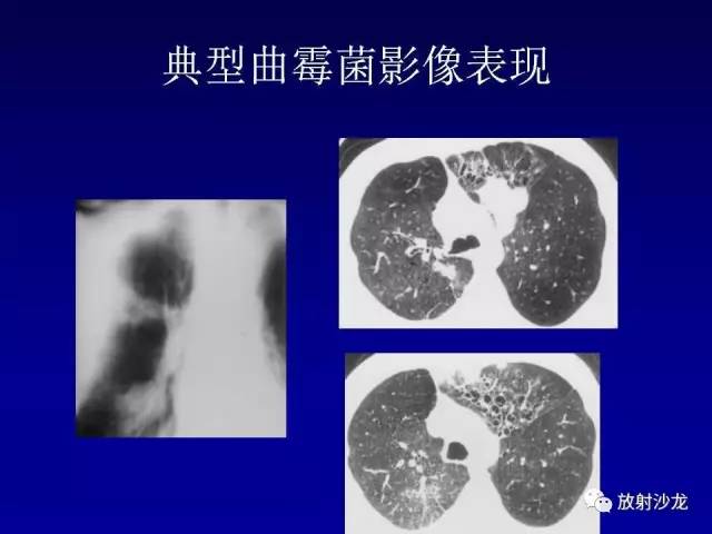 【PPT】肺真菌病的影像诊断与鉴别诊断