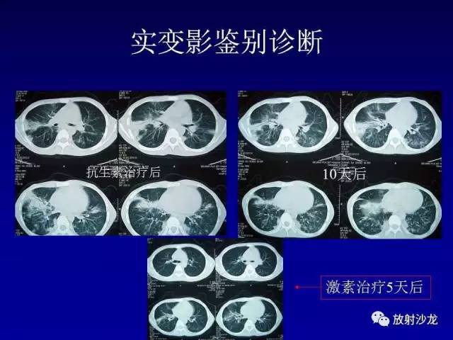 【PPT】肺真菌病的影像诊断与鉴别诊断