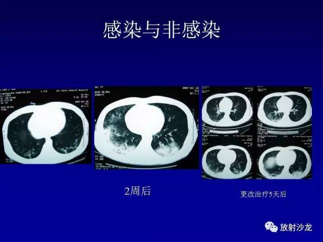 【PPT】肺真菌病的影像诊断与鉴别诊断