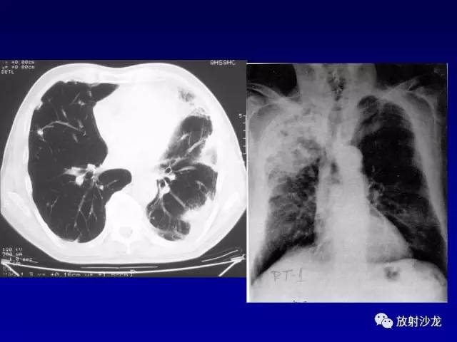 【PPT】肺真菌病的影像诊断与鉴别诊断
