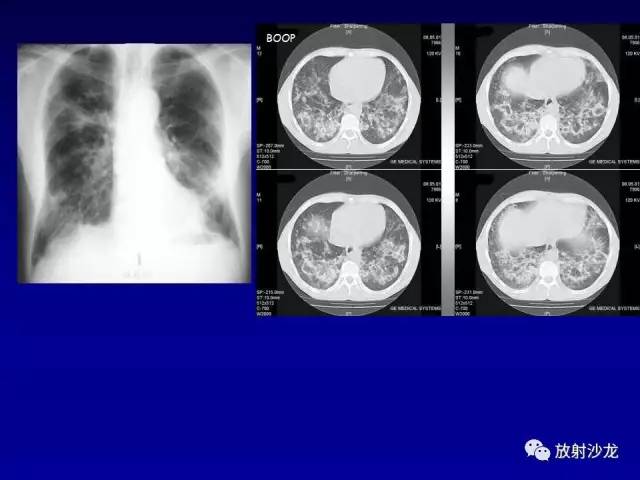 【PPT】肺真菌病的影像诊断与鉴别诊断