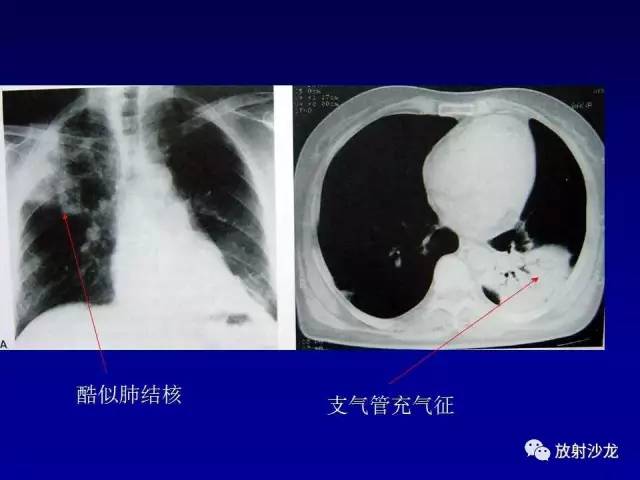 【PPT】肺真菌病的影像诊断与鉴别诊断