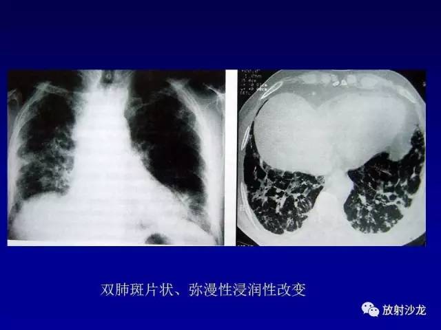 【PPT】肺真菌病的影像诊断与鉴别诊断