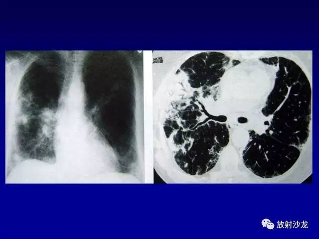 【PPT】肺真菌病的影像诊断与鉴别诊断