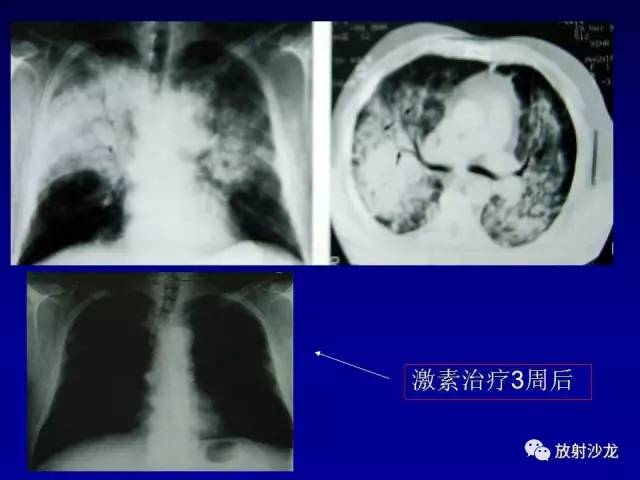 【PPT】肺真菌病的影像诊断与鉴别诊断