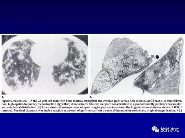 【PPT】肺真菌病的影像诊断与鉴别诊断