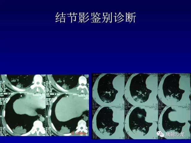 【PPT】肺真菌病的影像诊断与鉴别诊断