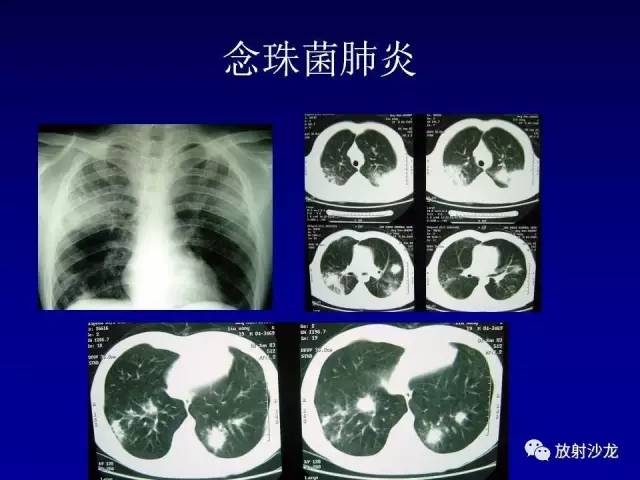 【PPT】肺真菌病的影像诊断与鉴别诊断