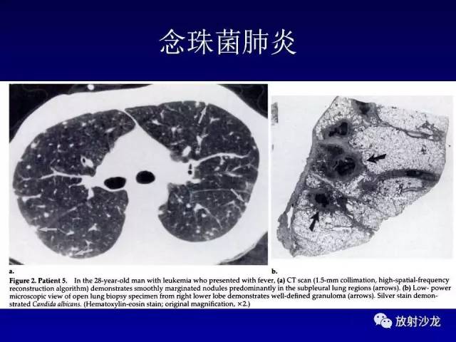 【PPT】肺真菌病的影像诊断与鉴别诊断