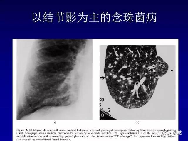 【PPT】肺真菌病的影像诊断与鉴别诊断