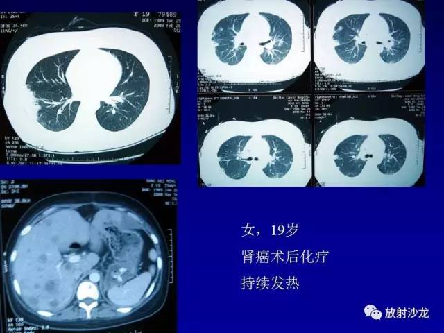 【PPT】肺真菌病的影像诊断与鉴别诊断