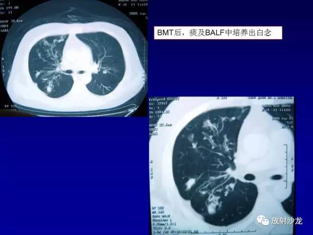 【PPT】肺真菌病的影像诊断与鉴别诊断