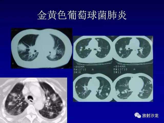 【PPT】肺真菌病的影像诊断与鉴别诊断