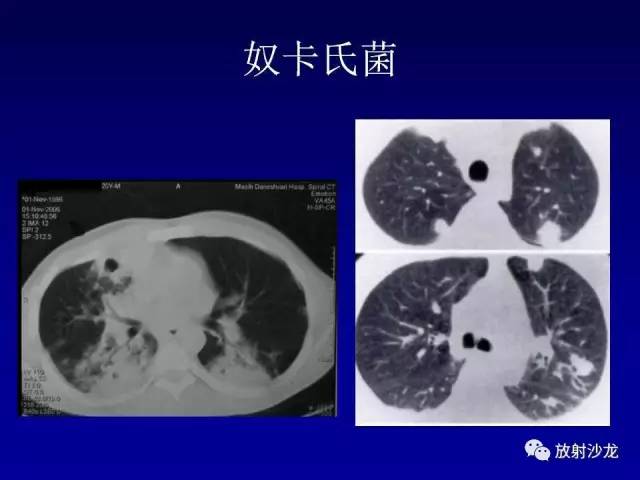 【PPT】肺真菌病的影像诊断与鉴别诊断