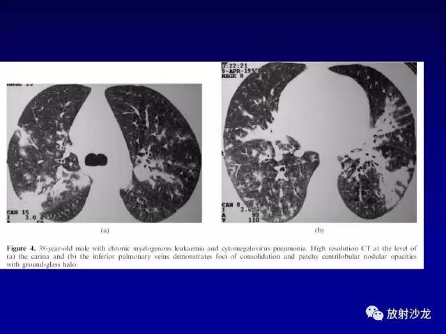 【PPT】肺真菌病的影像诊断与鉴别诊断