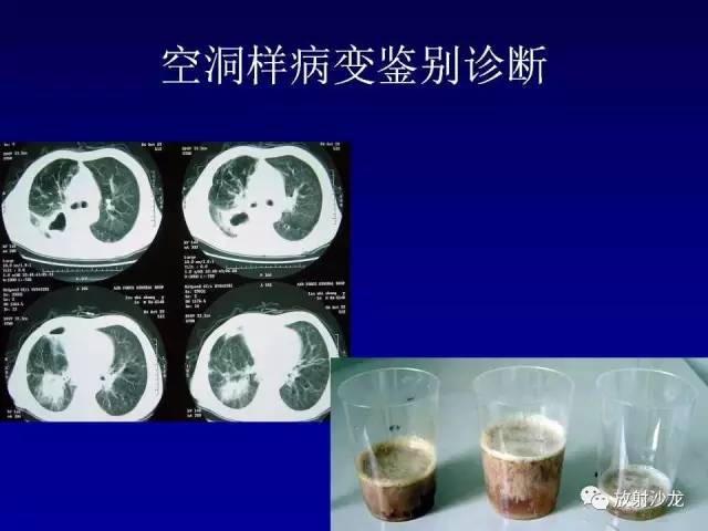 【PPT】肺真菌病的影像诊断与鉴别诊断
