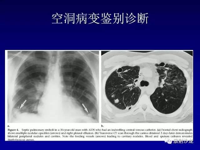 【PPT】肺真菌病的影像诊断与鉴别诊断