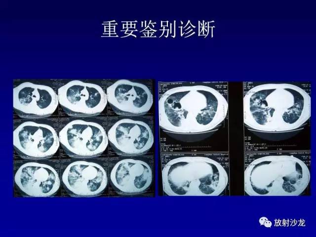 【PPT】肺真菌病的影像诊断与鉴别诊断