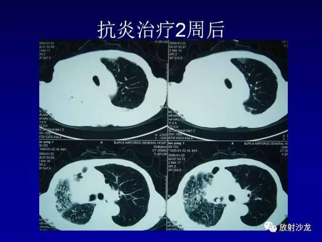 【PPT】肺真菌病的影像诊断与鉴别诊断