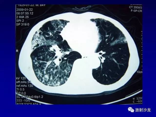 【PPT】肺真菌病的影像诊断与鉴别诊断