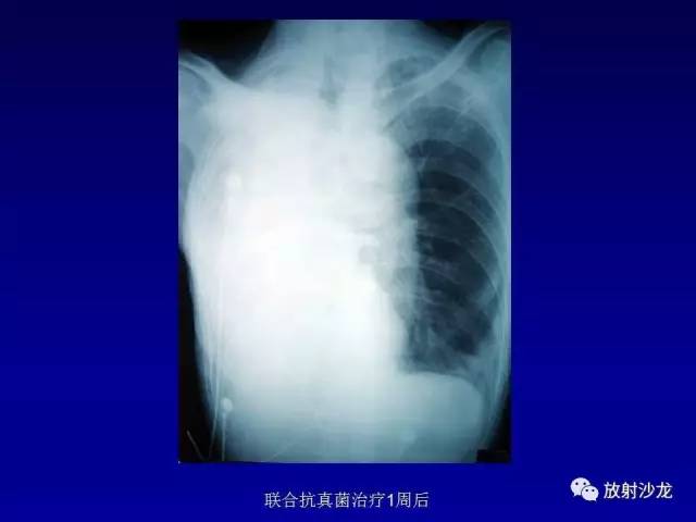 【PPT】肺真菌病的影像诊断与鉴别诊断